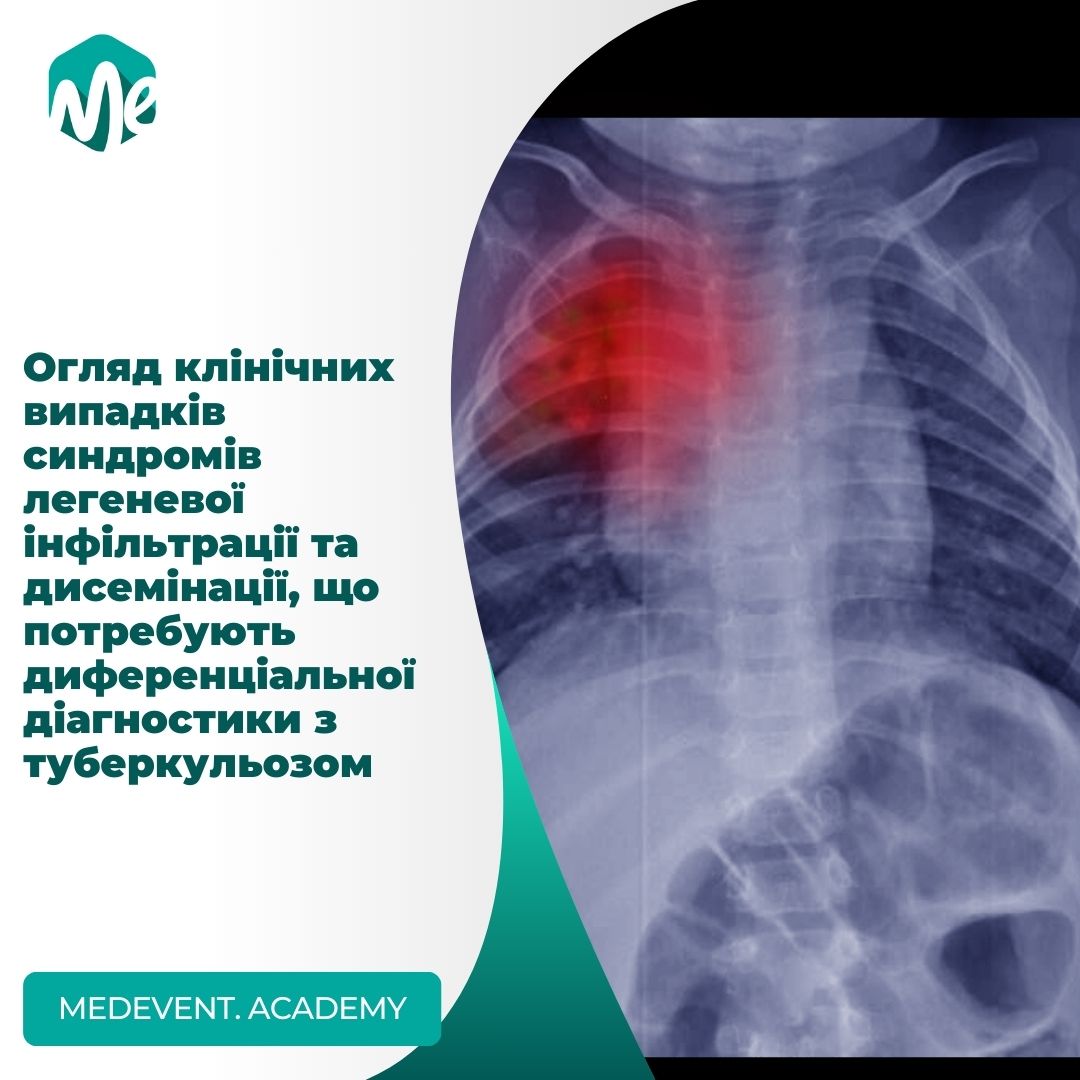 Огляд клінічних випадків синдромів легеневої