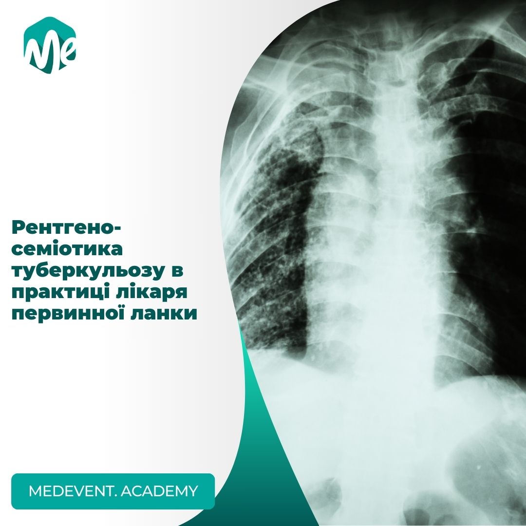 Рентгеносеміотика туберкульозу в практиці лікаря