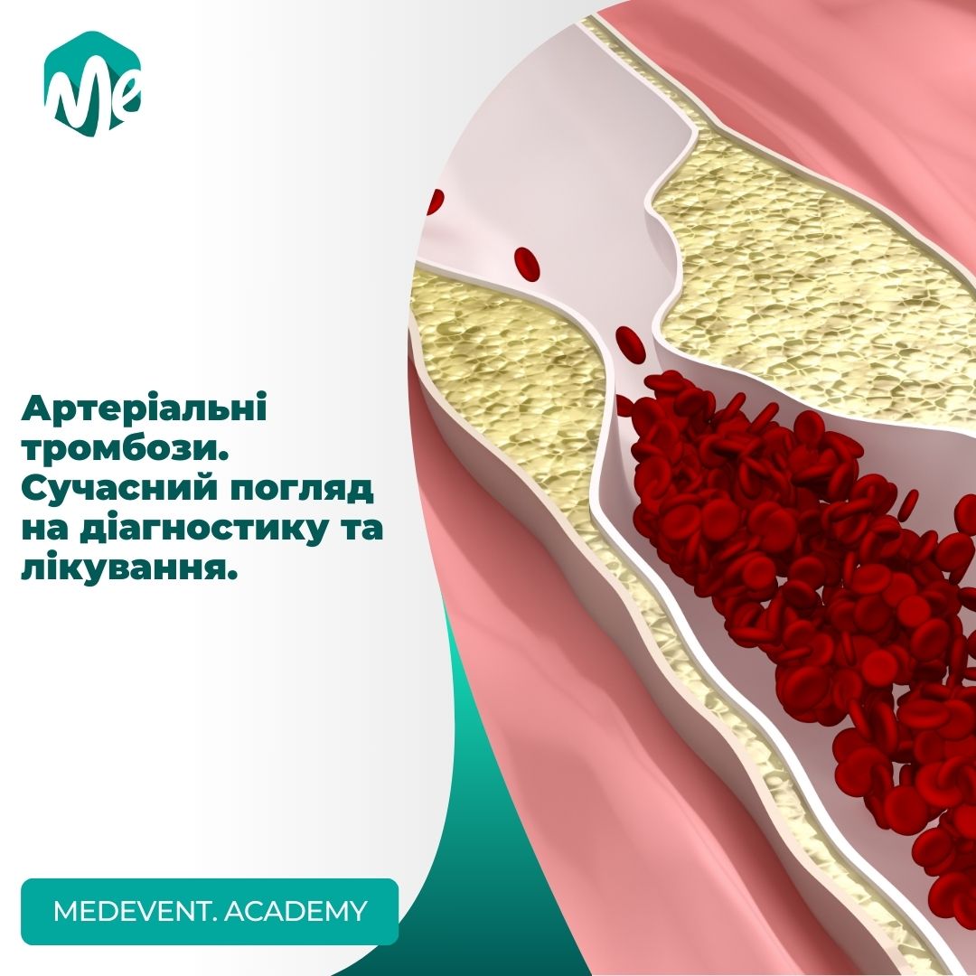Артеріальні тромбози. Сучасний погляд на