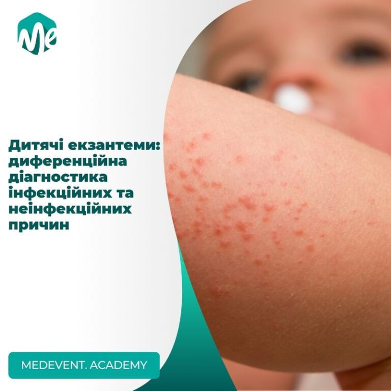 Дитячі екзантеми: диференційна діагностика інфекційних