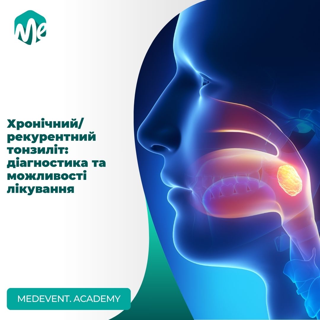 Хронічний/рекурентний тонзиліт