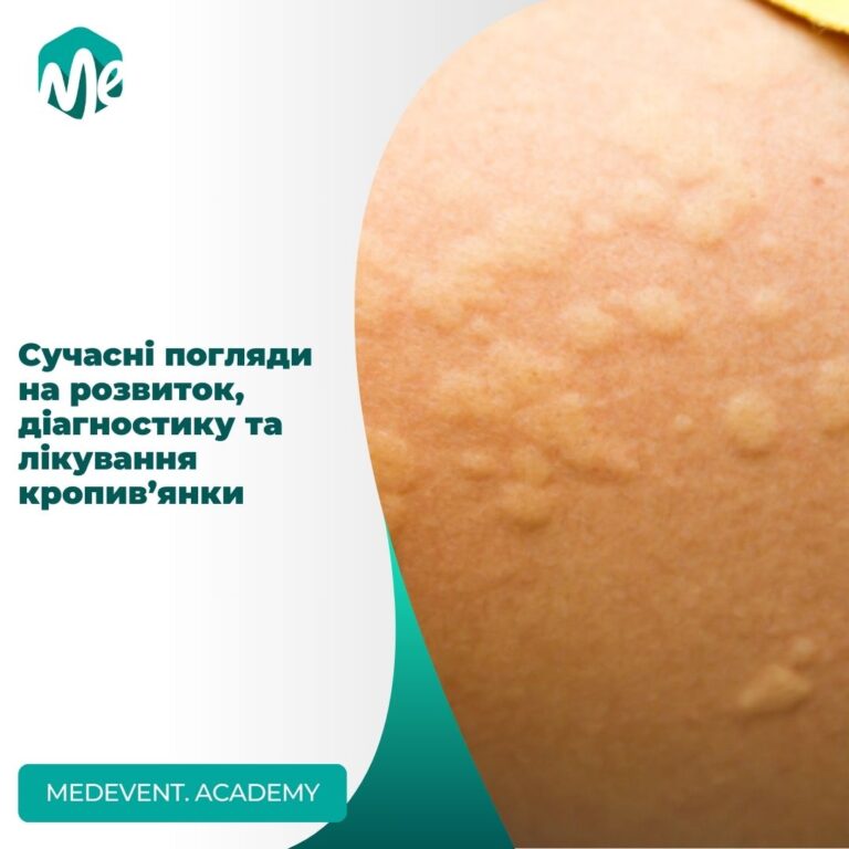 Сучасні погляди на розвиток, діагностику та лікування кропив’янки